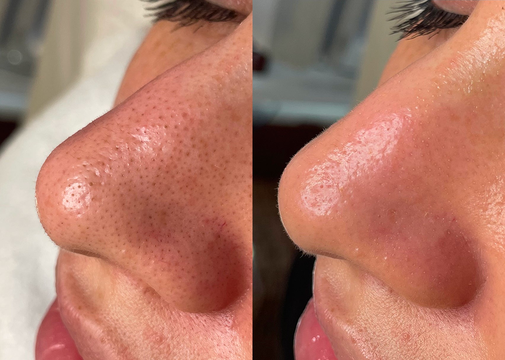 Side-by-side before-and-after image of a client's nose, showing reduced blackheads and clearer skin after a Hydrafacial session.