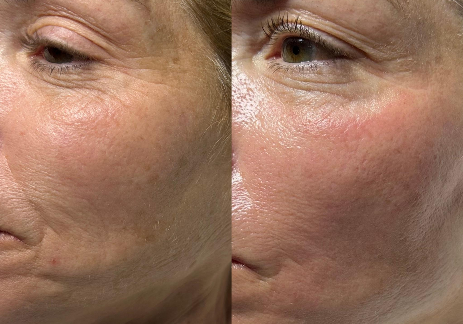 Side-by-side comparison of a woman's cheek area before and after treatment, showing differences in fine lines and wrinkles.